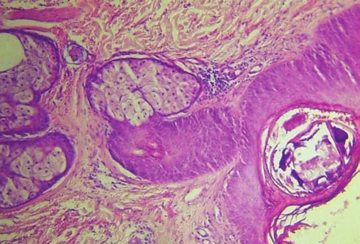 Intraepidermálně dilatovaný folikl se zbytky parazita, v okolí nevelké chronické zánětlivé infiltráty převážně lymfocyty, (zvětšení 100x)