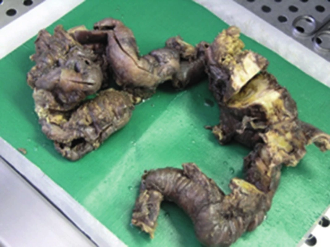 Makroskopické pitevné nálezy poukazujú na rozsah a hrúbku osifikácie zostávajúcej časti čreva
Fig. 6: Macroscopic autopsy findings indicate the extent and thickness of ossification of the residual part of the intestine