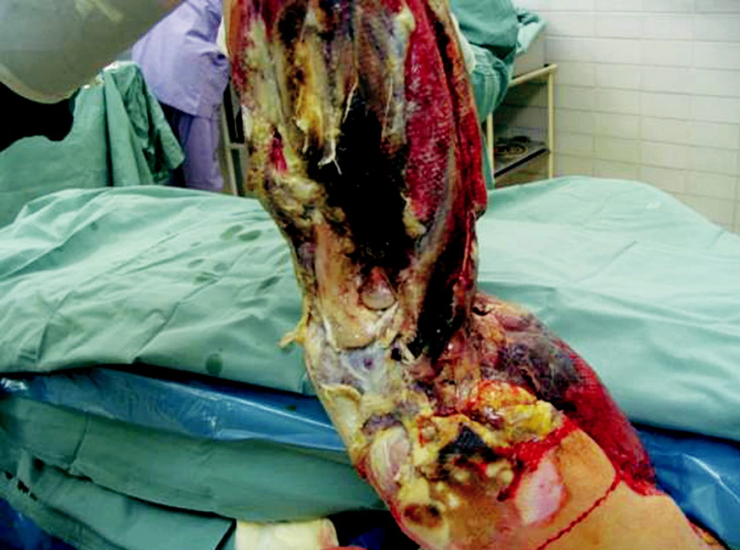 Left upper extremity eighth day after the injury