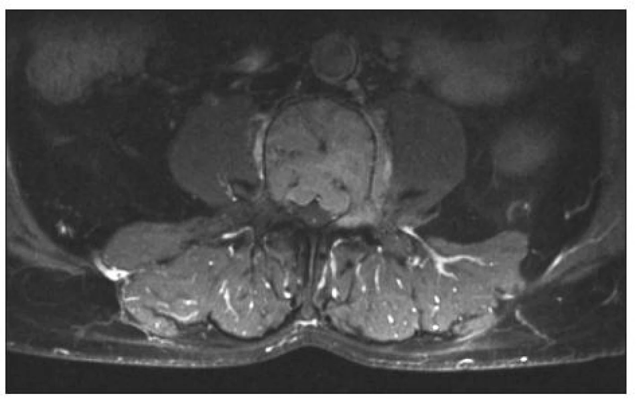 MR lumbosakrální páteře, axiální sken, T2 zobrazení. Propagace tumoru do kanálu páteřního a paravertebrálně,
obratel L3
Fig. 2. MRI, lumbosacral spine, axial view, T2 imaging. Paravertebral spread of the tumor and its spread into the spinal canal, L3 level