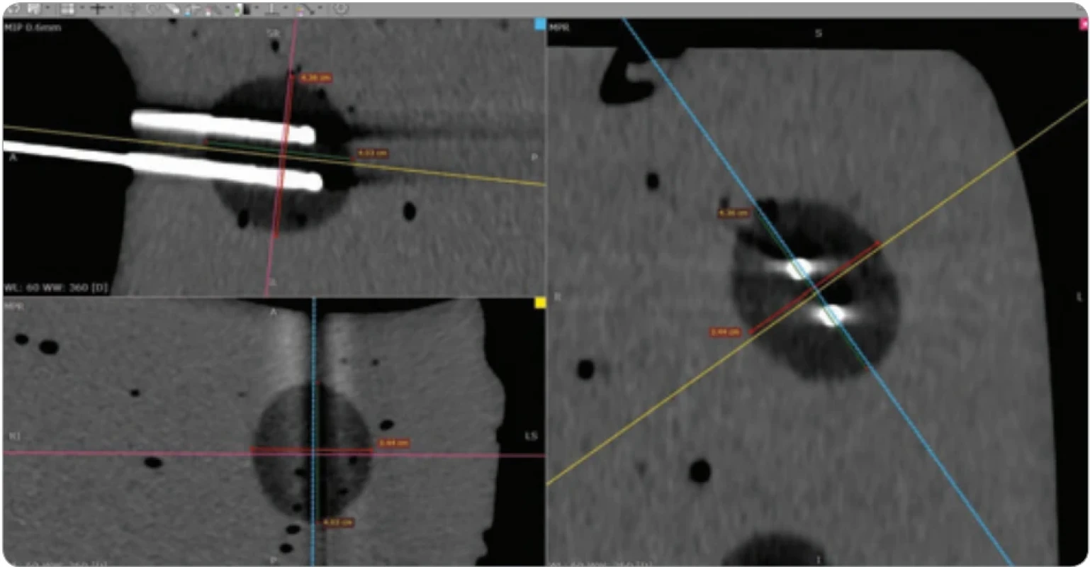 CT scan of the ice ball created using the double IceSphere™ needle confi guration after a 10-minute freezing cycle at 100% intensity.