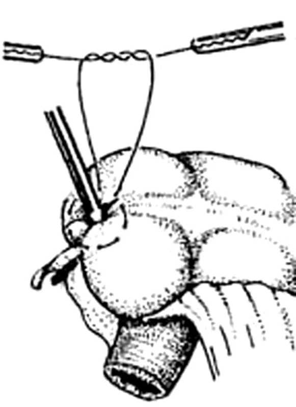 Laparoskopická apendektomie – laparoskopické zanoření pahýlu červu, peritonealizace
Fig. 7. Laparoscopic appendectomy – laparoscopic insertion of the appendix stump, peritonealization