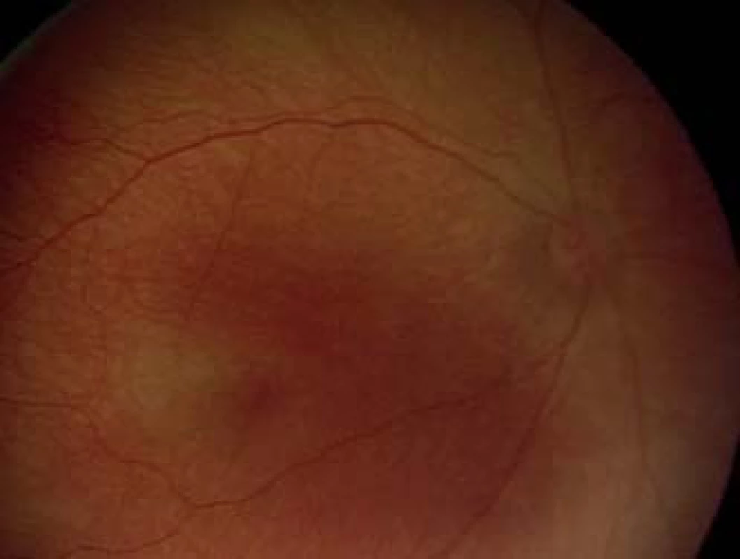 Pre-plus forma ROP – prítomná výrazná dilatácia vén a tortuozita arteriol ako obvykle