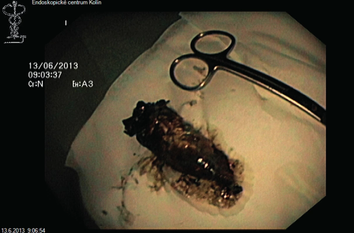 Extrahovaná nekróza
Fig. 5: Extracted necrosis