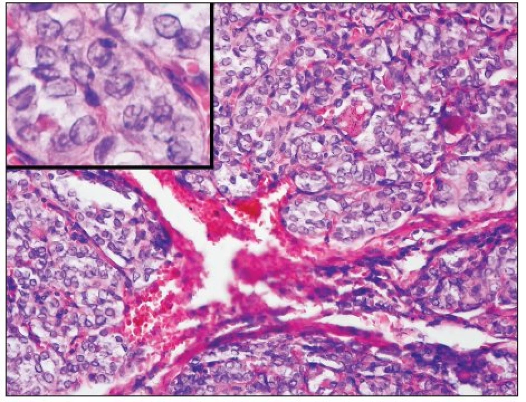 Solidní varianta papilokarcinomu vykazuje obdobně jako PDC solidně-alveolární uspořádání, jeho jádra však mají typický matnicový charakter – detail (H&amp;E, 100krát, detail 400krát)