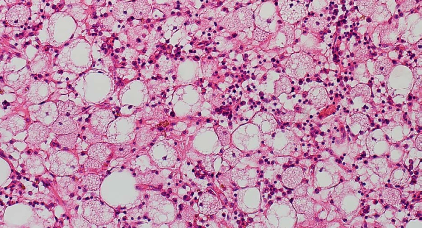 Histopatologický nález (hematoxylin-eosin, zvětšení 100×, Nomarského diferenciální interferenční kontrast, foto: J. Novák)
Fig. 5. Histopathological finding (H&amp;E stain, magnification 100×, Nomarski differential interference contrast, photo: J. Novák)
