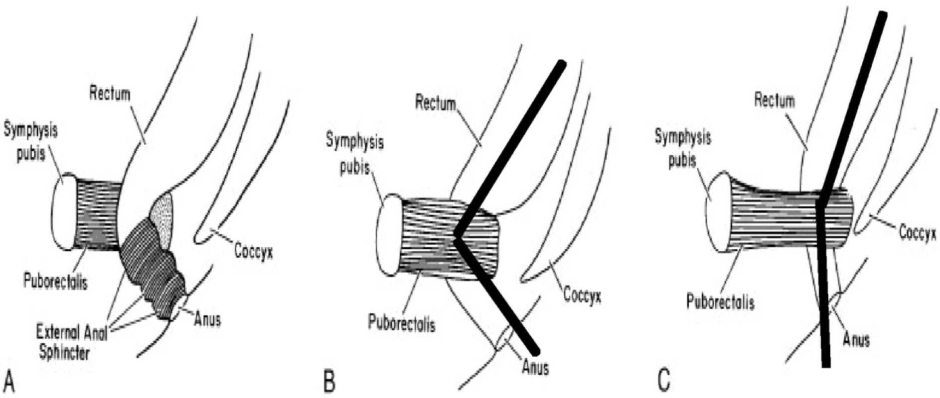 Mechanismus relaxace svalů pánevního dna při defekaci
A (vlevo): rektum a kontrahovaný m. puborectalis, ostrý anorektální úhel a zevní svěrač
B (uprostřed): klidový stav – kontrahovaný m. puborectalis a ostrý anorektální úhel
C (vpravo): defekace – relaxace m. puborectalis a napfiímení anorektálního úhlu