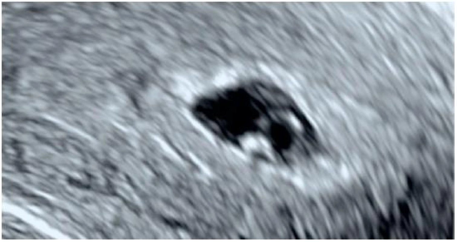 Intrauterinní těhotenství na konci 6. gestačního týdne
Ultrazvukové zobrazení gestačního váčku se sekundárním žloutkovým váčkem a embryem o maximální délce (CRL) 3,5 mm (odpovídá grav. hebd. 5+6), při vyšetření patrná pulzace (srdeční akce).