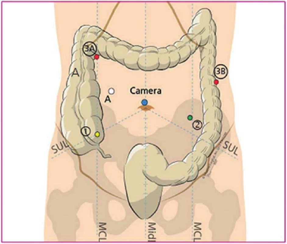 Rozmístění portů při da Vinci asistované resekci rekta (J. Lagares-Garcia)
Fig. 1. Port placement for da Vinci assisted low anterior resection of the rectum (J. Lagares-Garcia)