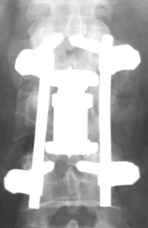 Implantovaný koš Synex, předozadní projekce
Pic. 3. Implanted Synex cage, AP view