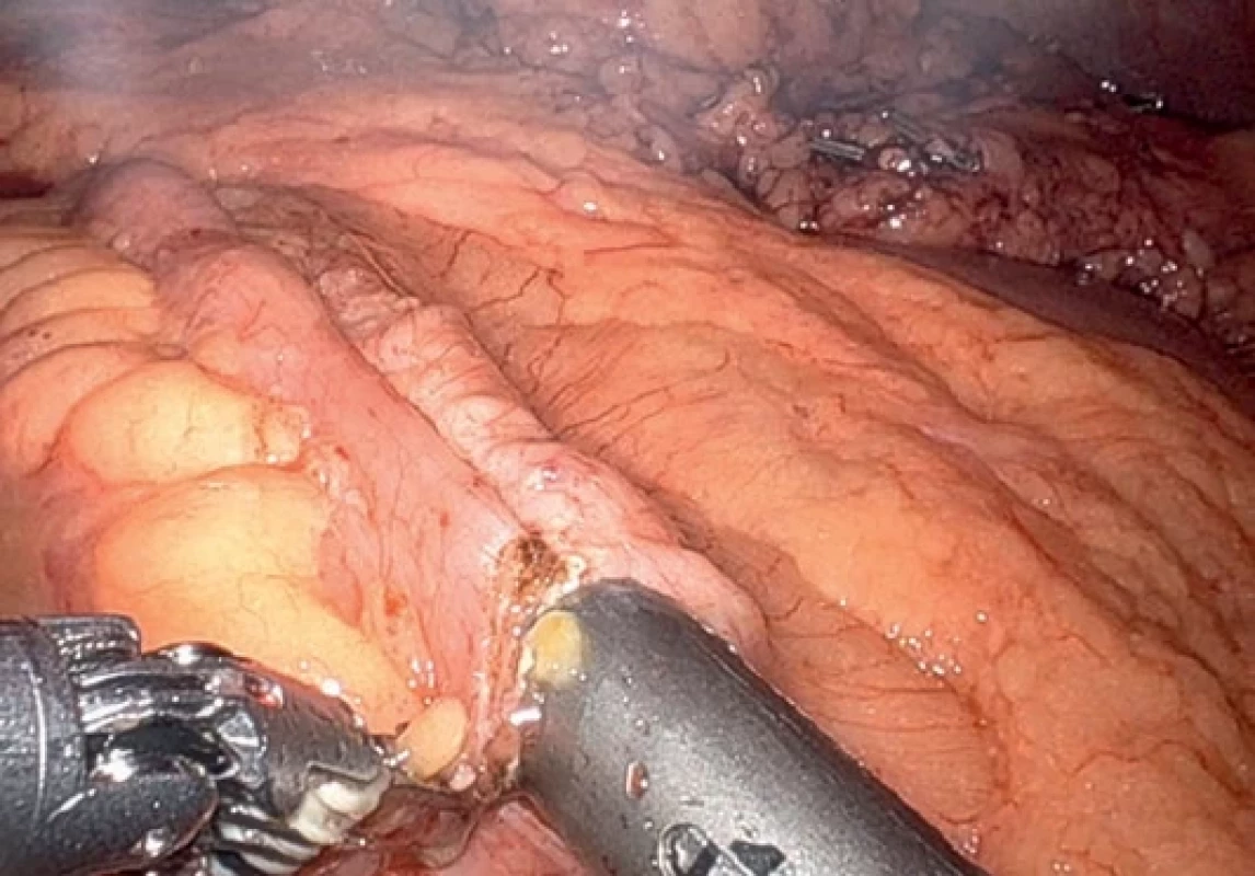  Konstrukce anastomózy robotickým Da Vinci systémem  po pravostranné hemikolektomii.  Anastomosis construction using Da Vinci robotic system  after right sided hemicolectomy.
