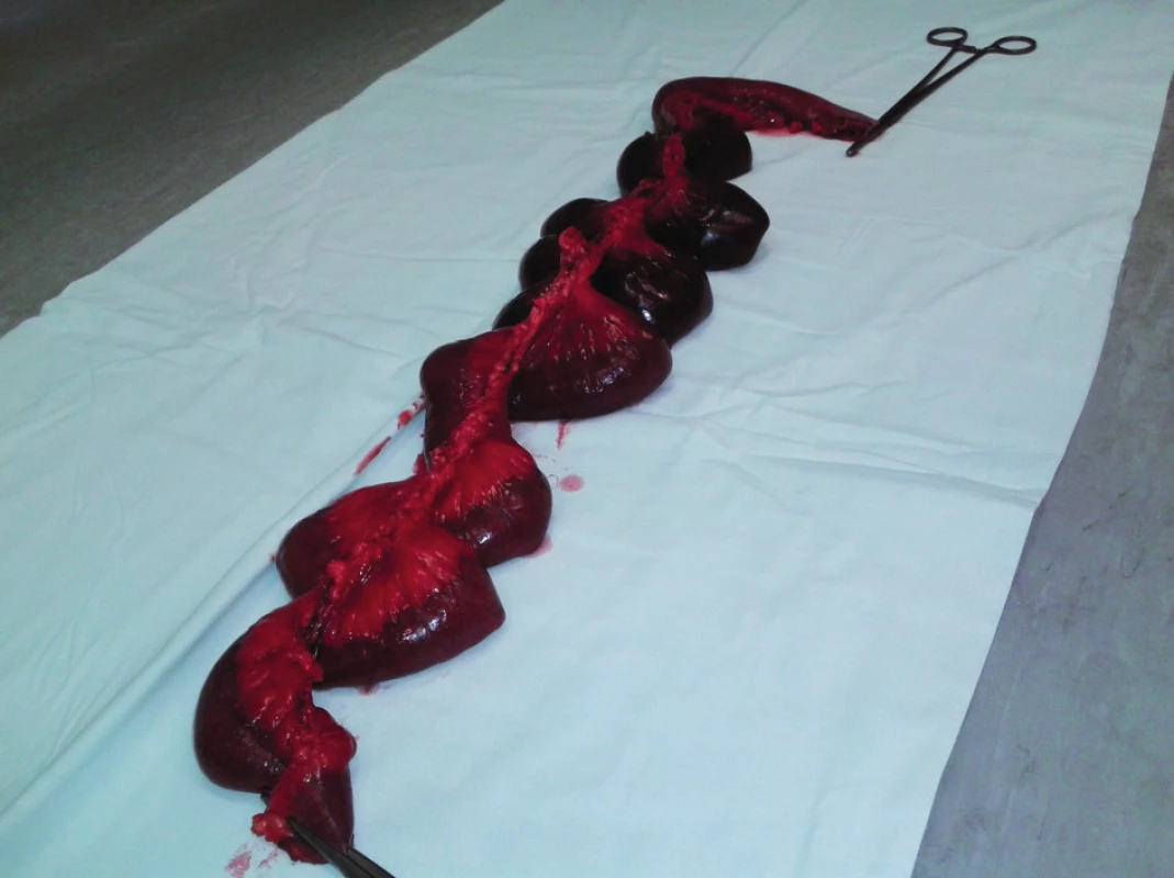 Resekát nekrotického čreva
Fig: 1: Necrotic bowel resected