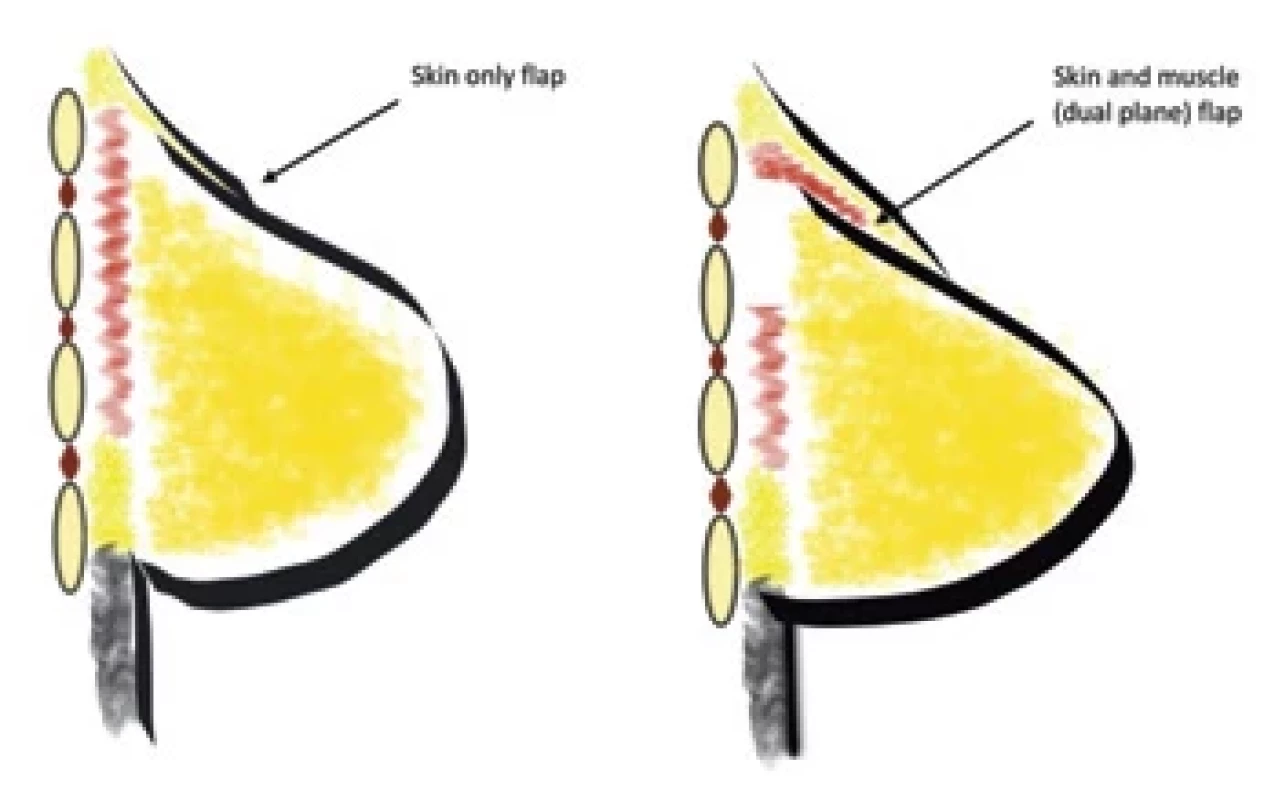 Gravvanis et al. (2015) investigated outcomes diff erence between single vs. dual plane inset [1].