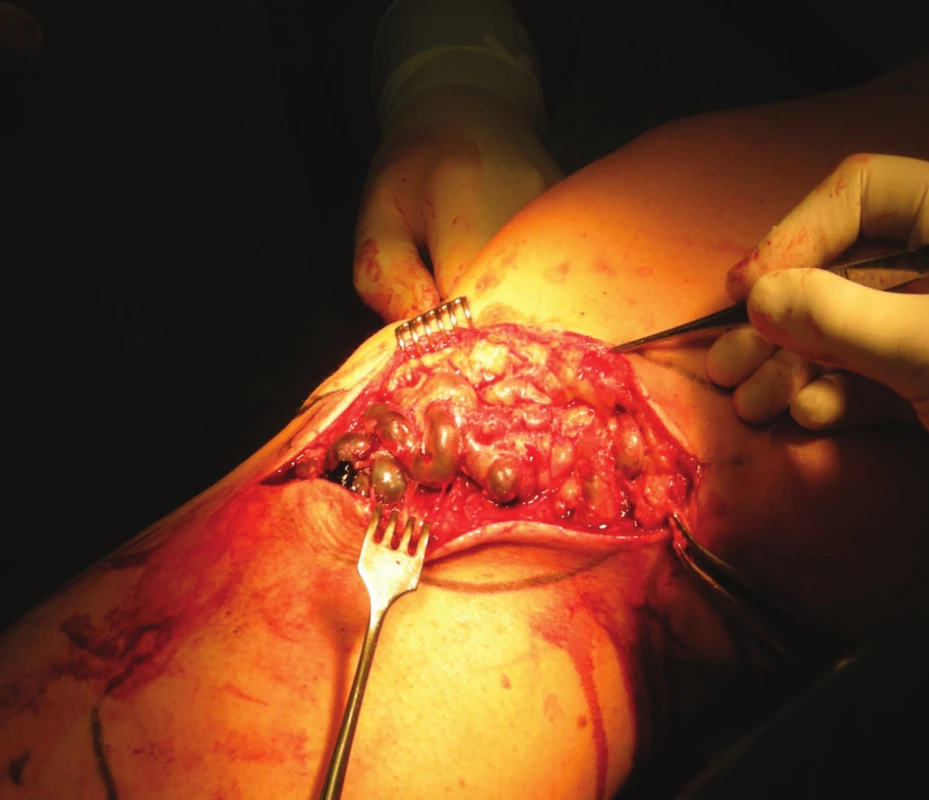 Operační situs trombozovaného varikózního konvolutu
Fig. 2: Perioperative image of convoluted varicose veins