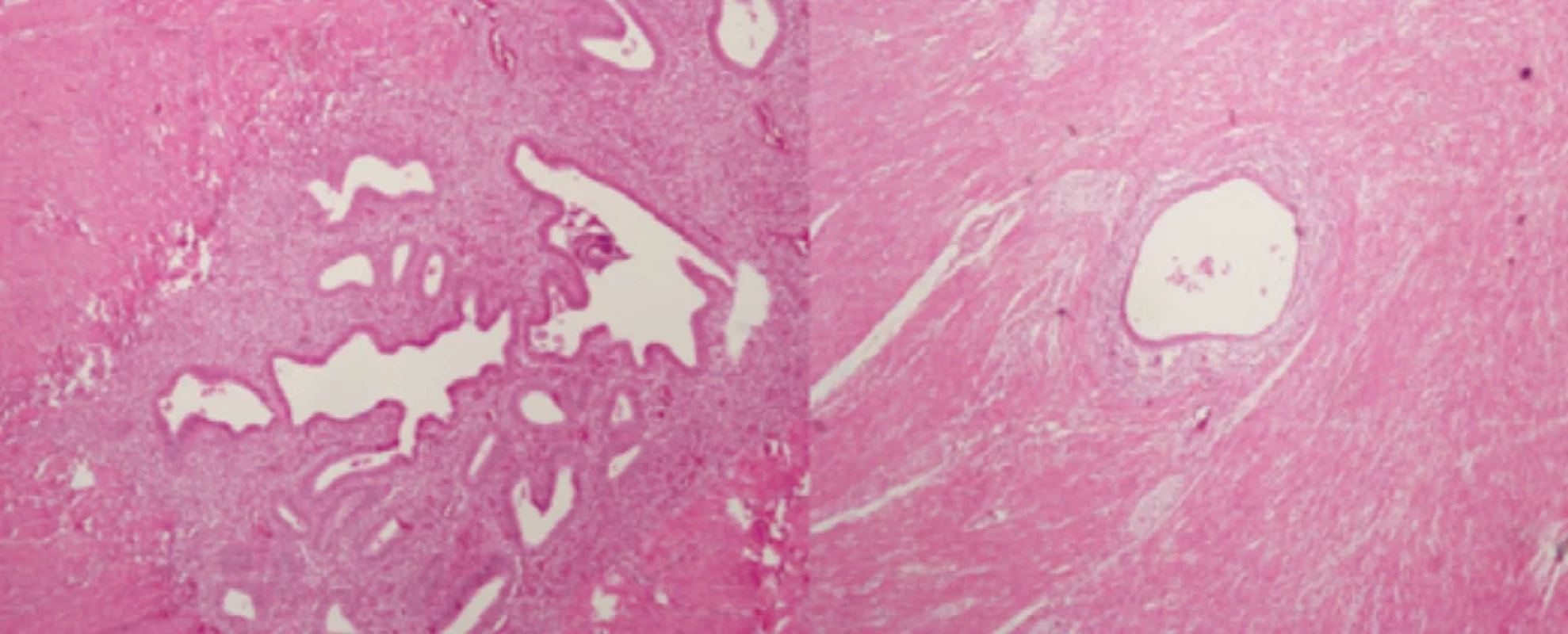 Specimen in hematoxylin eosin, rectum left, vagina right. Obr. 6. Preparát v hematosylin-eosinu, vlevo rektum, vpravo pochva.