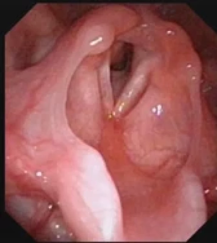Subglotický hemangiom, fl exibilní laryngoskopie. Fig. 3. Hemangioma of subglottis, fl exible laryngoscopy.
