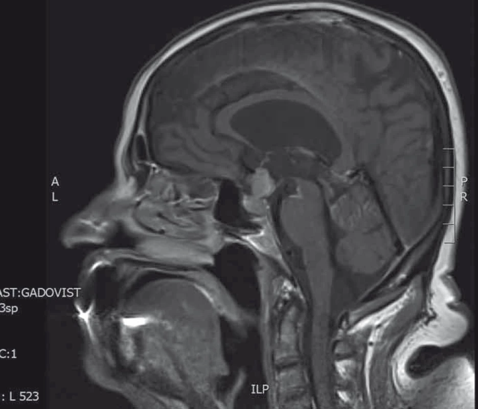 MRI hypofýzy (T1 vážené sagitální skeny s kontrastní látkou).
Selární tumorózní expanze tvaru přesýpacích hodin.