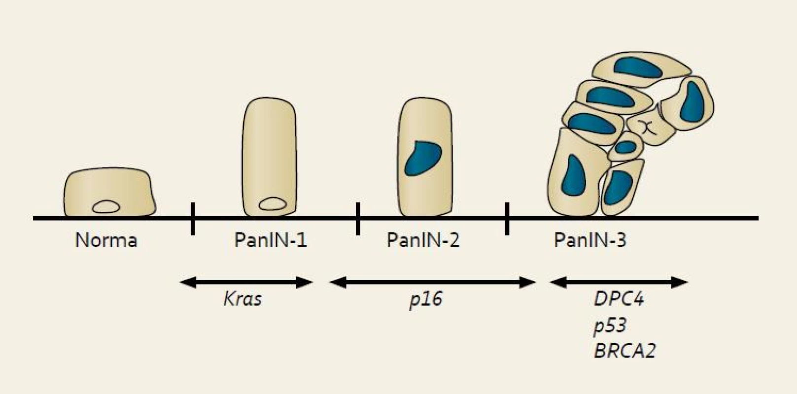 Model histologické a genetické progrese duktálního adenokarcinomu pankreatu.
Fig. 1. Model of the histological and genetic progression of the ductal adenocarcinoma of the pancreas.