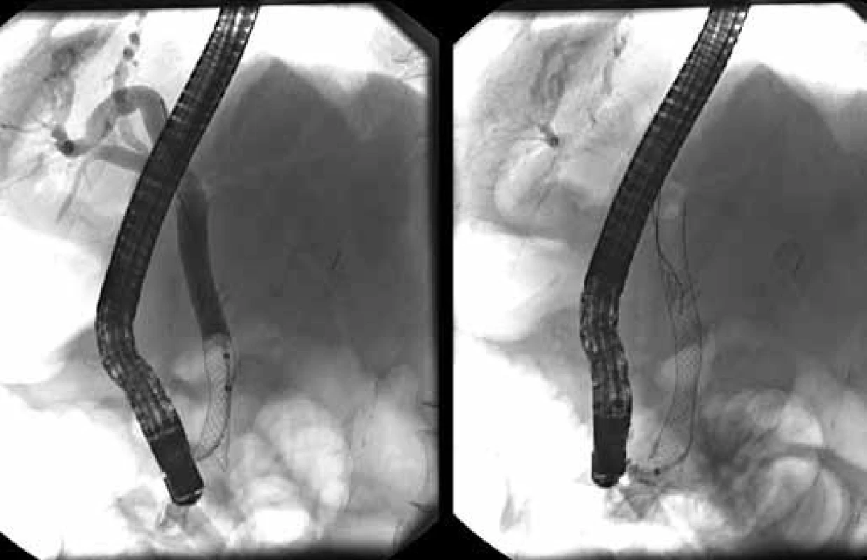 Vľavo mierne vtiahnutý biliárny kovový stent deň po jeho zavedení, vpravo stent po jeho povytiahnutí do dvanástnika.
Fig. 7. On the left side is visible partially indwelled biliary metallic stent, on the right side biliary stent after its withdrawal into the duodenum.