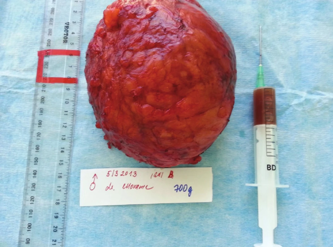 Cysta vážící 700 g, ovoidního tvaru velikosti 150x100x90 mm, ve stříkačce tekutina z cysty
Fig. 3: Cyst weighing 700 g., of ovoid shape and size 150x100x90mm, fluid from the cyst in the syringe