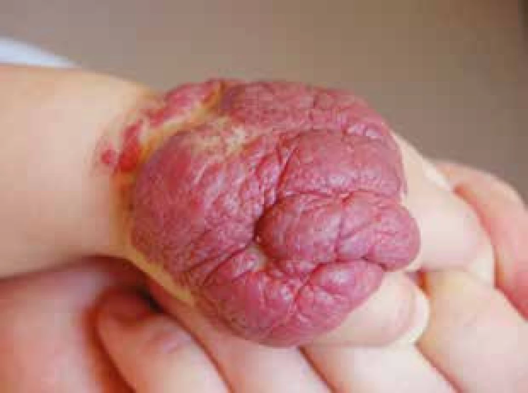 Laločnatý infantilní hemangiom ruky s rizikem rezidua postihujícím funkci ruky.
Fig. 8. Large segmental infantile hemangioma with the risk of impact of the extremity function.