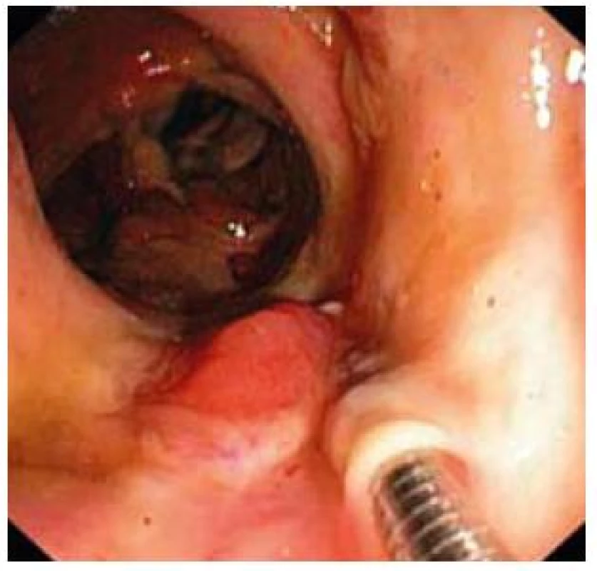Demarkácia ulcerózne zmenenej sliznice v colon ascendens.
Fig. 6. Flaking of ulcerative mucosa in colon ascendens.
