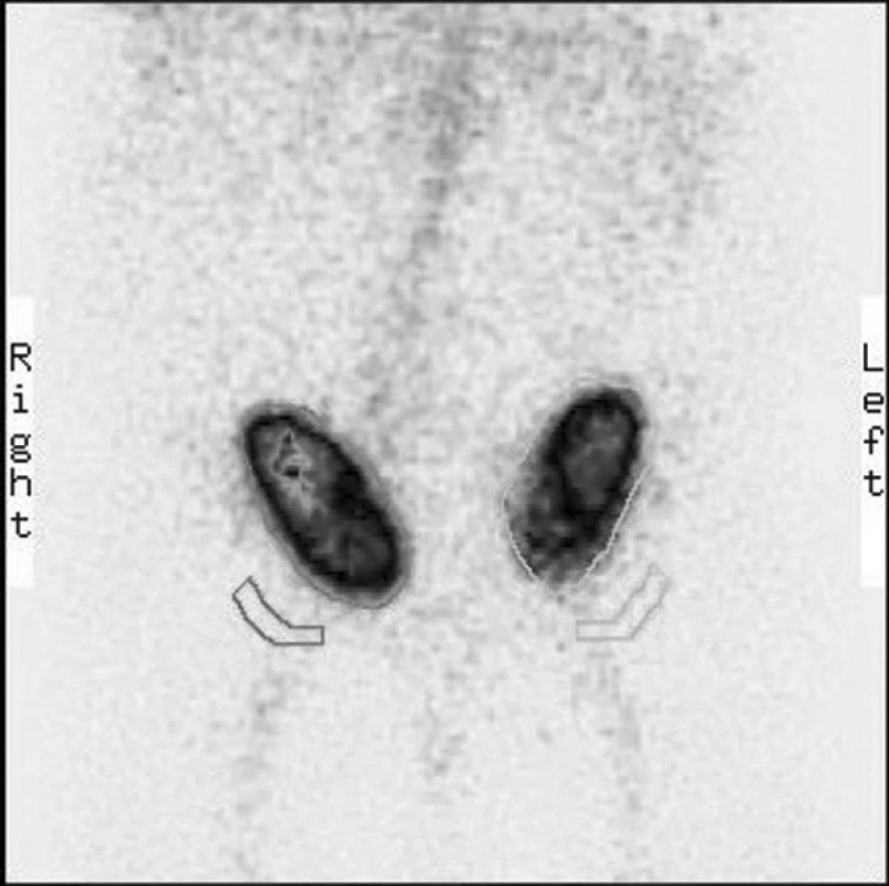 Scintigrafie
Fig. 4. Scintigraphy