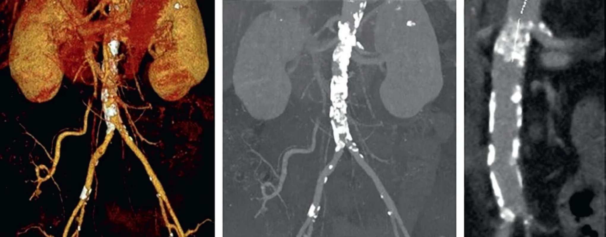Computer tomography angiography (CTAG) of the abdominal aorta.Počítačová tomografická angiografie (CTAG) břišní aorty.
