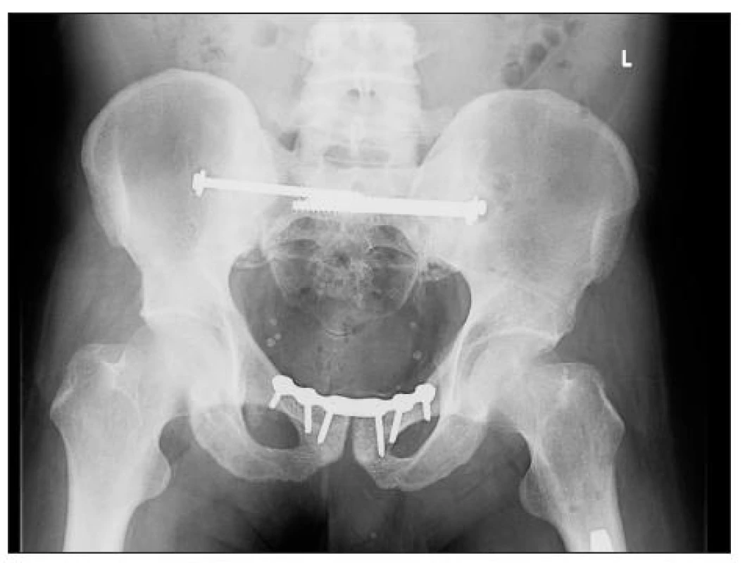 RTG snímek pánve po konverzi zevní fixace na vnitřní osteosyntézu předního i zadního segmentu pánve
Fig. 3. X-ray picture of definitive internal fixation both anterior and posterior parts of pelvic ring