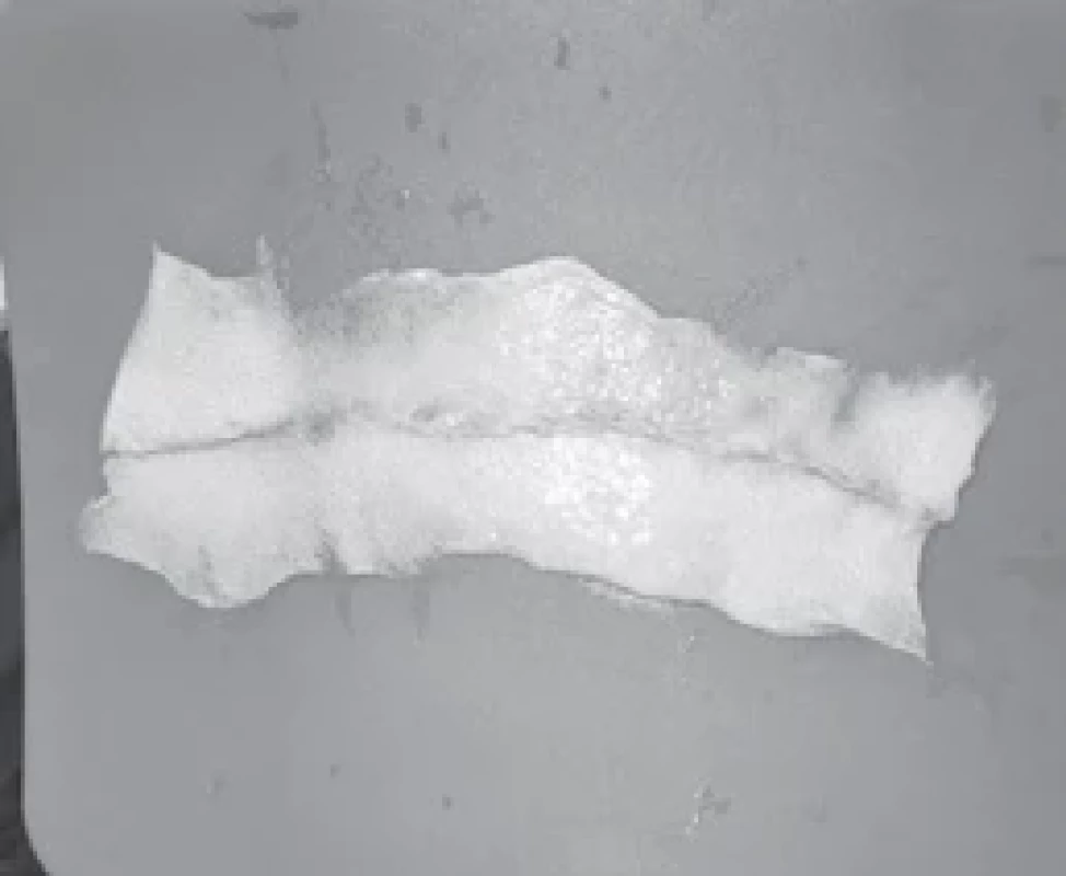 ADM two pieces sutured togeather, ready to be sutured to the patient body.
