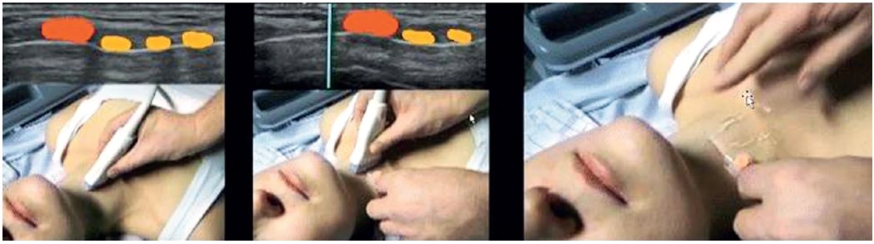 Lokalizace krikothyroidní membrány s využitím akustického stínu na kůži přiložené flexily