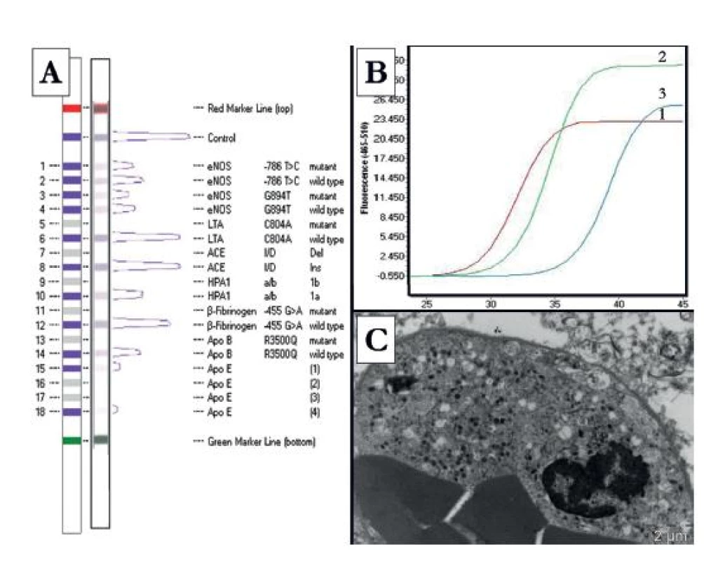 Panel A demonstrated the results of strip assay using a kit CVD StripAssay. B: Panel B demonstrated amplification plots of VEGF gene using the kit Assays VEGF in Light Cycler LC480 II. C: In patients with SOL was identified plugging of leucocytes in capillaries. Curved line 1 demonstrates standard sample, concentration of cDNA 1.00 μg/μl. Curved line 2 demonstrates sample of contused brain tissue, concentration of cDNA 7.84 μg/μl. Curved line 3 demonstrates sample of diffuse axonal injuried brain tissue, concentration of cDNA 1.92 μg/μl.