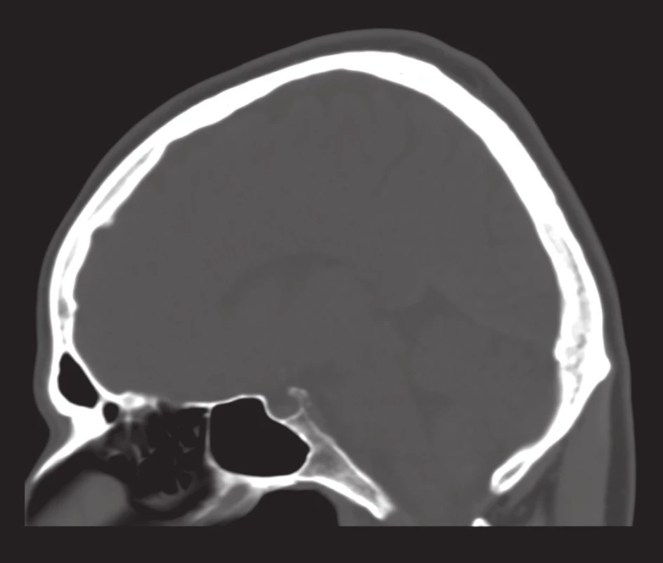 Selární typ pneumatizace sfenoidální dutiny: nejčastější varianta
Fig. 5: Sellar type of sphenoid sinus pneumatisation: the most common type