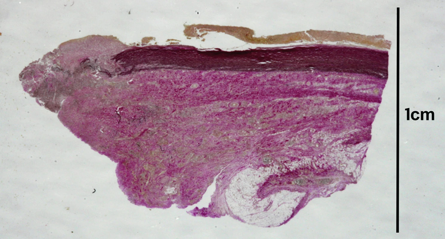 Histotopogram pseudoaneuryzmy aorty s fibroproduktívnymi zmenami (van Gieson 
+ elastika).