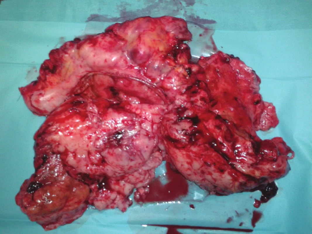 Resekovaná nádorová masa (transversum, žaludek, mesokolon)
Fig. 4: Resected tumor mass (transversum, stomach, mesocolon)