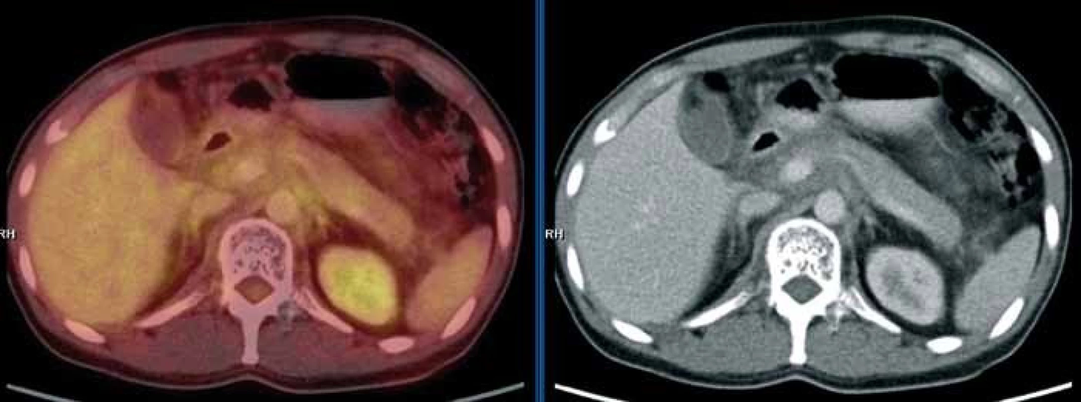 PET/CT vyšetření s podáním i.v. kontrastu provedené v září 2010. Mediastinem, jaterním hilem a kaudálněji celým retroperitoneálním prostorem se spolu s cévami pruhovitě táhne „cárovitě“ hypodenzní (hemagiomatózní) infiltrát, jehož metabolická aktivita je srovnatelná s pozadím. Lze tedy říct, že ani kostní postižení, ani infiltrát v mediastinu, retroperitoneu nevykazoval patologickou míru konzumpce FDG, kterou běžně vídáme u většiny ložisek maligní etiologie.