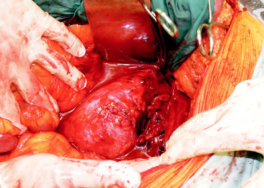 Ruptura AAA u 76letého nemocného Hardmanův index 1
Fig. 6. Ruptured AAA in a 76-year old patient, the Hardman index score 1