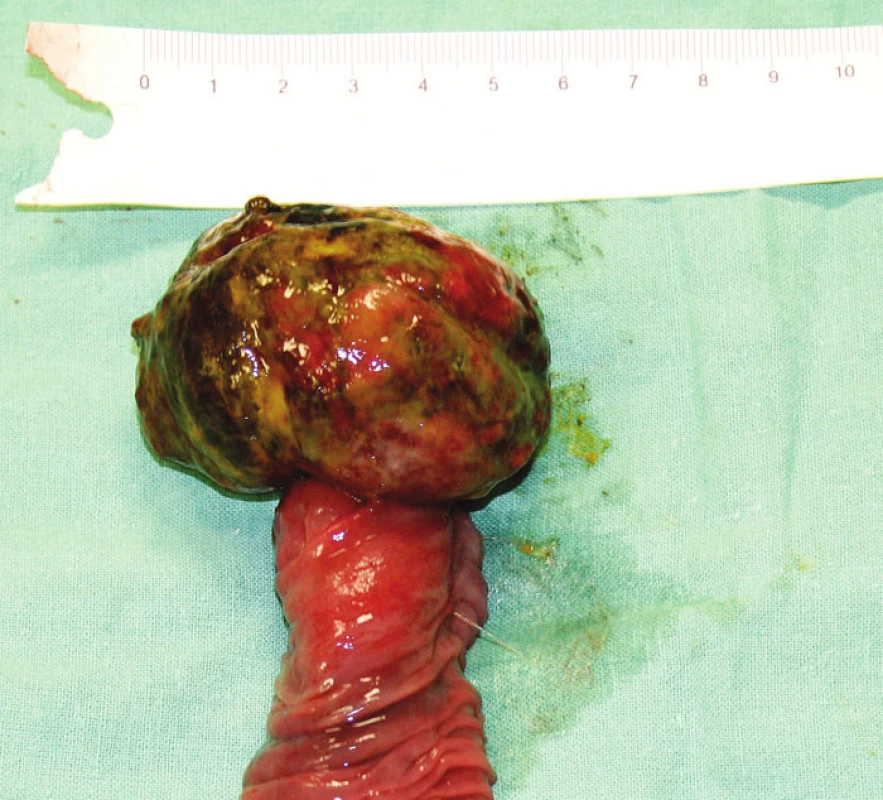 Metastáza maligního melanomu v jejunu
Fig. 1. Jejunal malignant melanoma metastasis