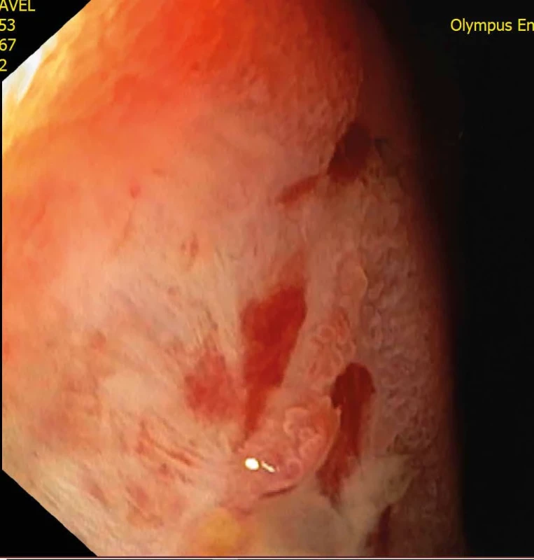 Duodenoskopie Fig. 6: Duodenoscopy