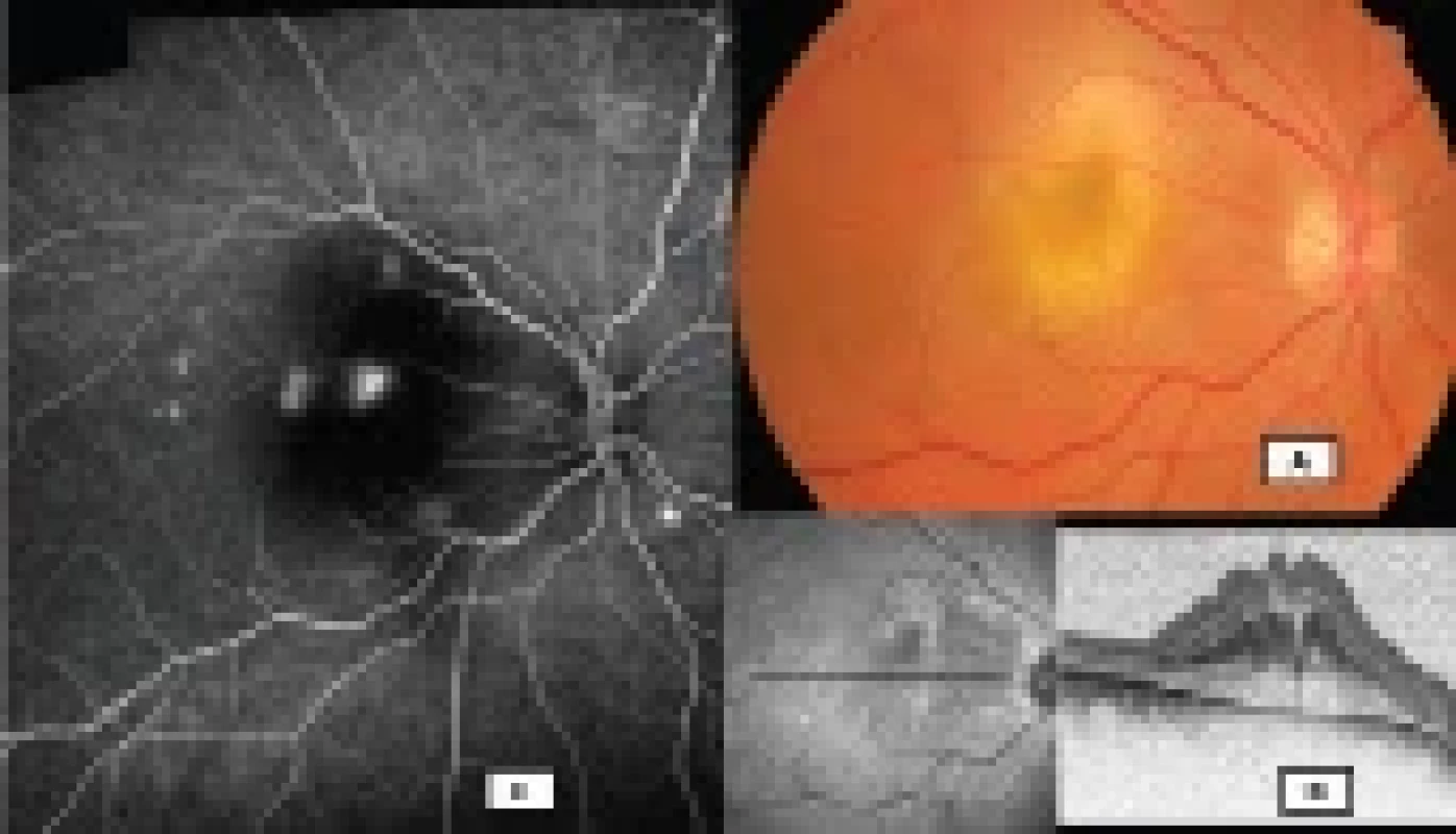 Barevné foto fundu, sken optické koherenční tomografie a fluorescenční angiografie (Visucam Zeiss, Heidelberg Spectralis, Myslík Manethová)