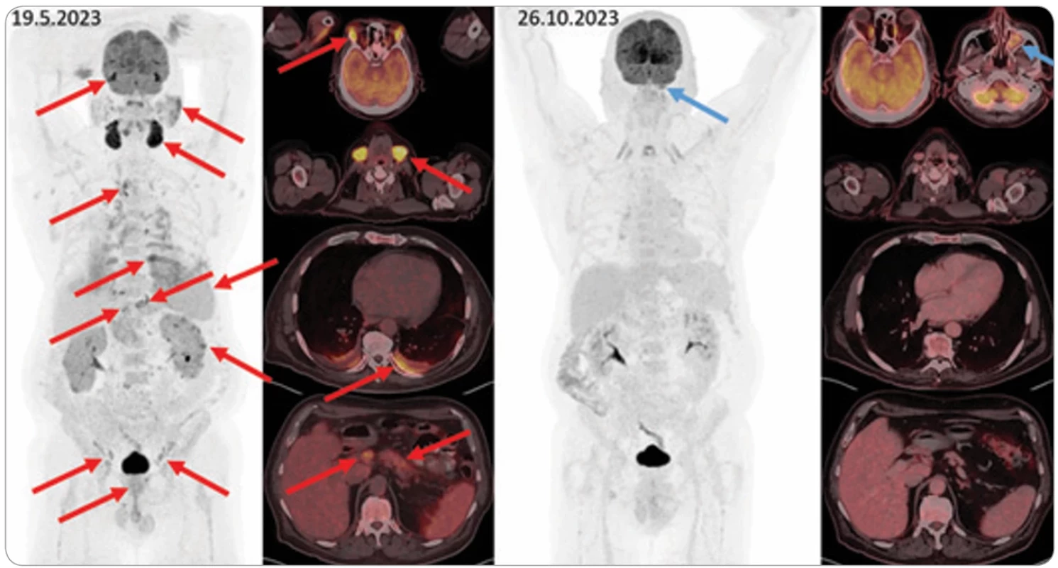 PET/CT Mikuliczovy choroby. Iniciální FDG-PET/CT vyšetření (vlevo) a kontrolní vyšetření při terapii (vpravo), vždy MIP sken hlavy  a trupu a fúzované axiální řezy s detaily. Na iniciálním vyšetření jsou extrémně metabolicky aktivní slzné žlázy (akumulace dokonce pře sahuje fyziologicky vysokou akumulaci v mozku) a podčelistní slinné žlázy. Zvýšené akumulace 18F-fl uorodeoxyglukózy jsou patrny i v pří ušních a podjazykových slinných žlázách, uzlinách periklavikulárně, mediastina, epigastria, retroperitonea a ilicky oboustranně , dorzálně  v plicích, kde i fl uidothorax, v hlavě a těle slinivky, ložiska v kůře ledvin, aktivnější prostata, slezina difuzně aktivnější než játra (tyto pato logie jsou označeny červenými šipkami). Na kontrolním vyšetření při terapii všechny tyto nálezy vymizely, nově jediná akumulace vlevo  v maxilární dutině (modré šipky, vs. zánět bez souvislosti se zákl. dg.).  MIP – projekce maximální intenzity