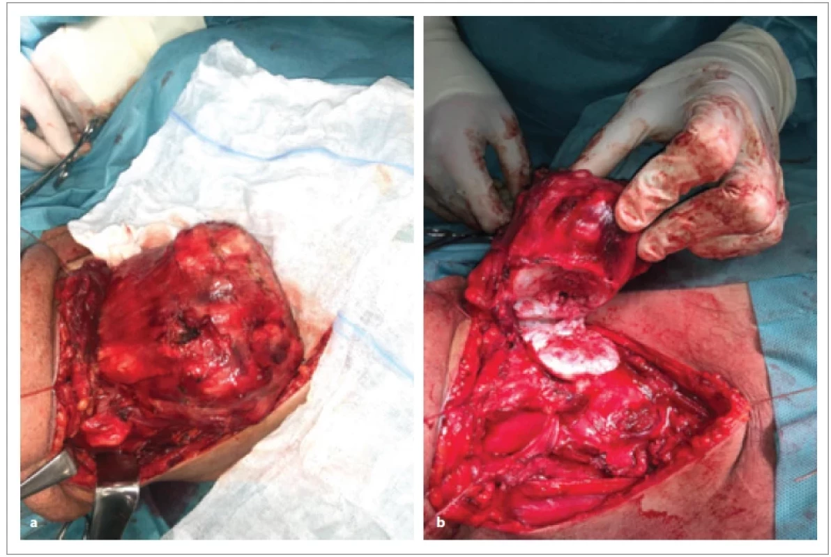3a) Peroperačný nález extraluminálne rastúceho tumoru; b) stopka tumoru vyrastajúca z oblúka prstienkovej chrupky.3a) Peroperative fi nding of extraluminal tumor growth; b) tumor pedicle growing from the arch of the annular cartilage.