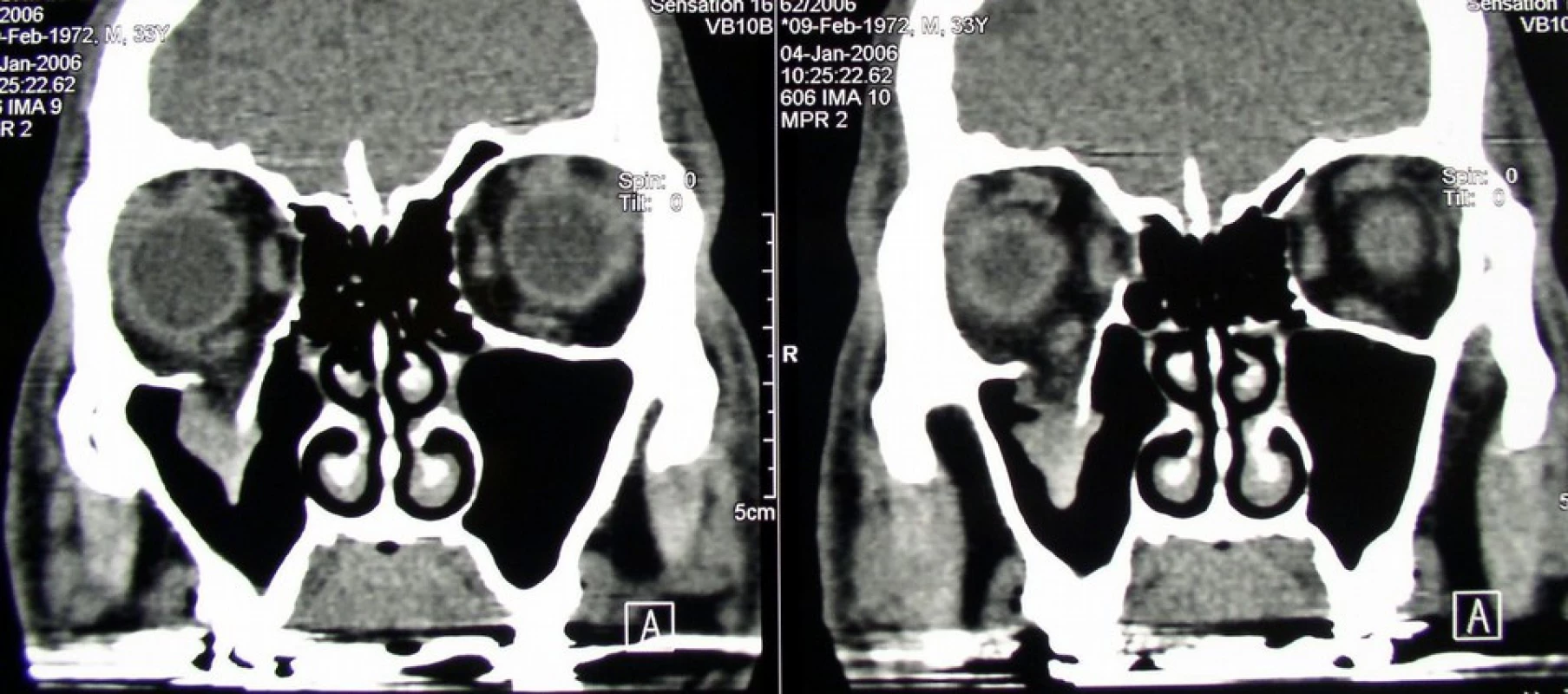 Izolovaná zlomenina spodiny očnice