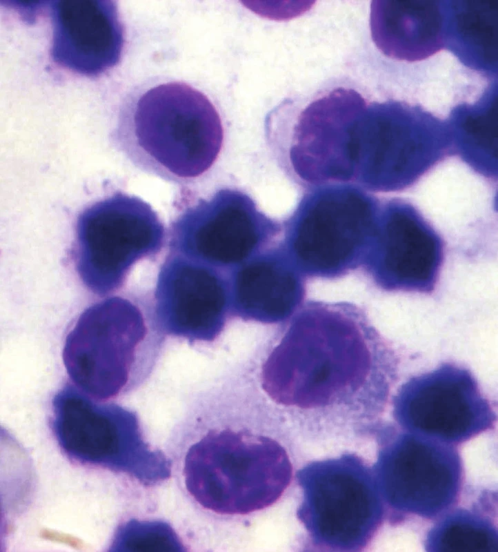 Cytologie z aspirační biopsie uzlu. barvení hematoxilin-eosinem, 1000násobné zvětšení
