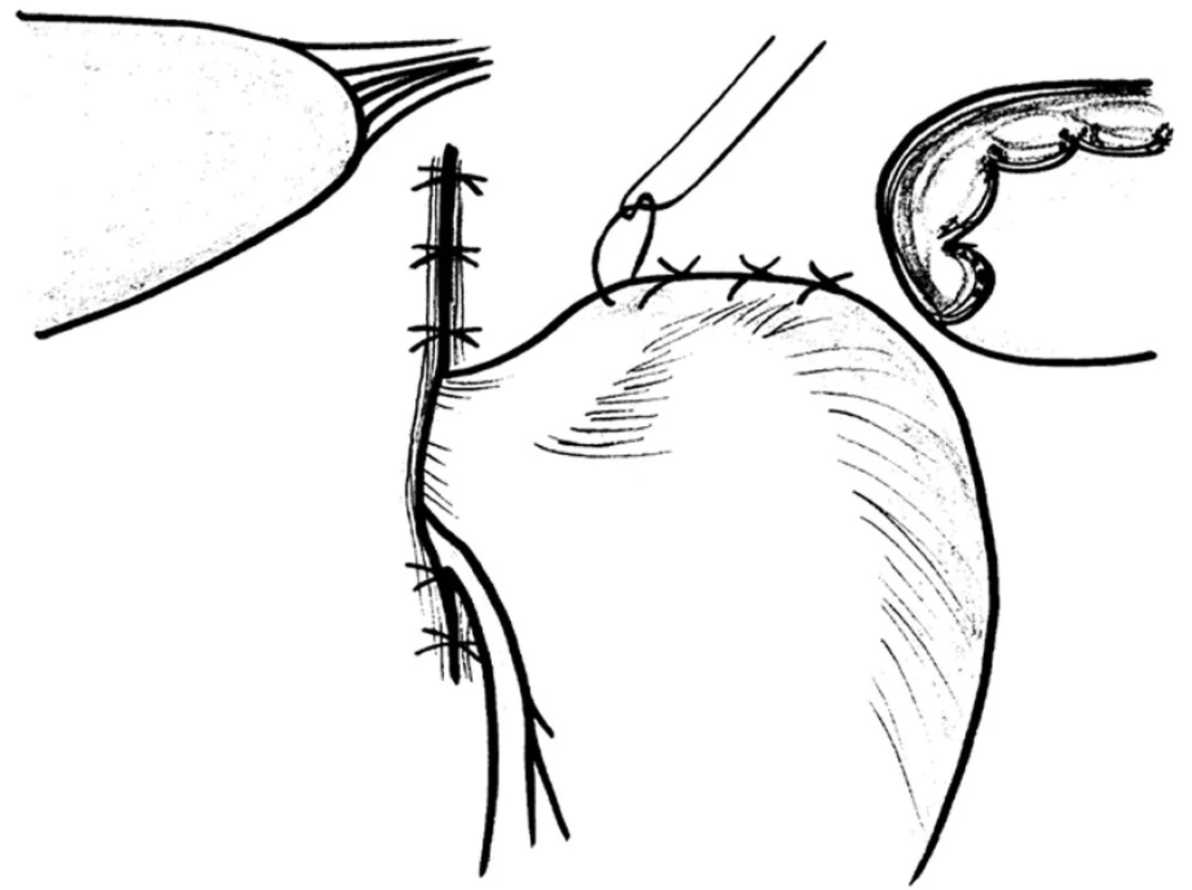 Schéma přední hiátorafie a fundofrenopexe
Fig. 16: Scheme of the anterior hiatorhaphy and fundophrenopexy