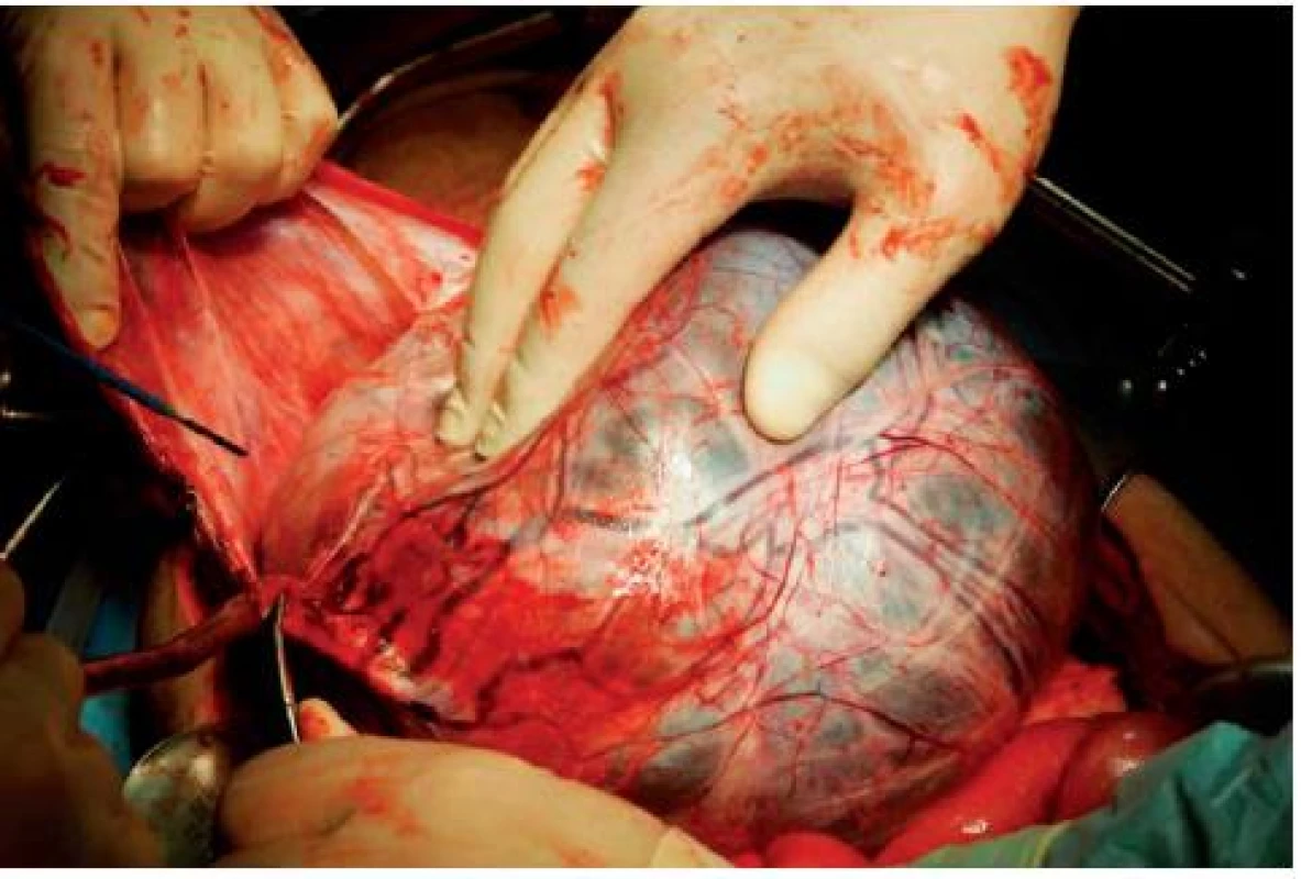 Abdominální vak hydrokély při operaci
Obr. 3. Abdominal sac hydrocele during surgery