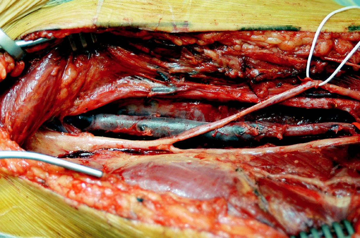Autologní vena femoralis superficialis
Fig. 2. Autologous superficial femoral vein