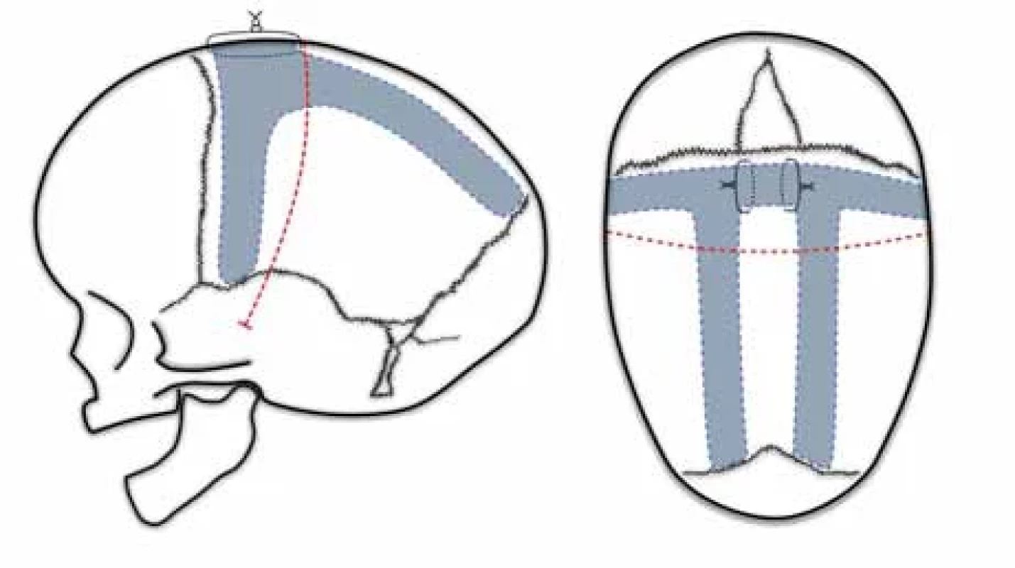 Pí technika / Fig. 3. Pi technique