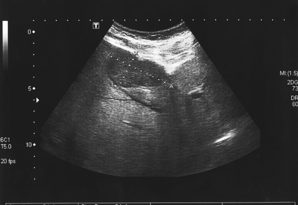 UZ jater s metastázou
Fig. 3. Liver ultrasound with a metastasis