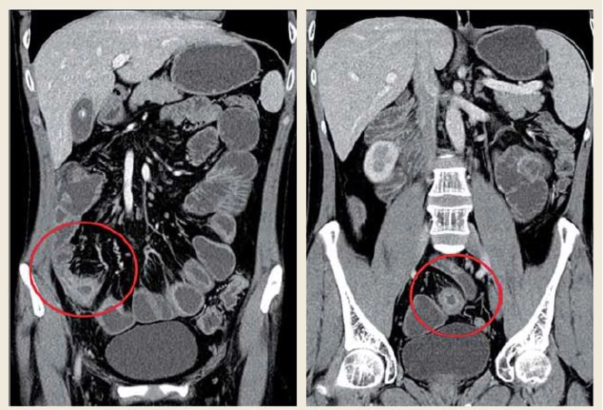 CT enterografie, říjen 2010: 5 skip lézí (délka 3-5 cm) na distálním ileu (celková délka 60 cm).
Fig. 1. CT enterography, October 2010: 5 skip lesions (length 3-5 cm) on distal ileum (total length 60 cm).